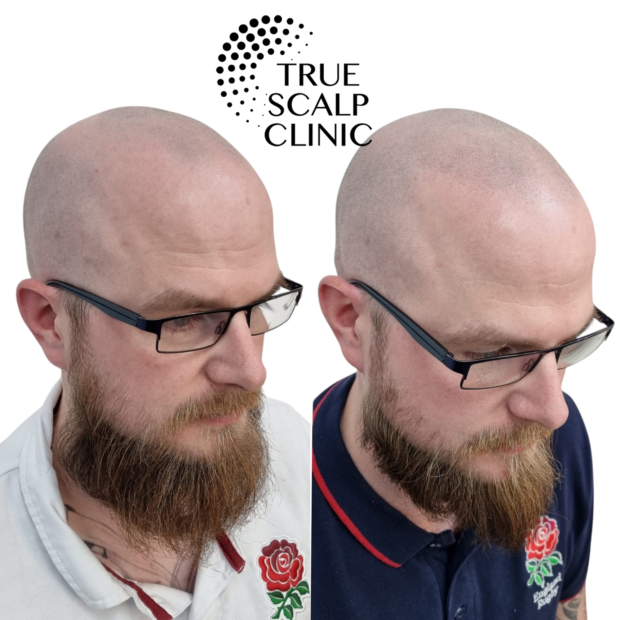 Trusted Expert for Scalp Micro Pigmentation in Milton Keynes