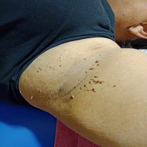 How Skin Tag Removal in Milton Keynes Can Improve Your Skin Health