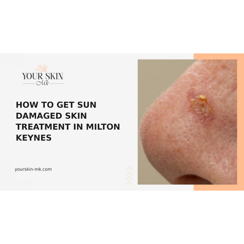 How to Get Sun Damaged Skin Treatment in Milton Keynes