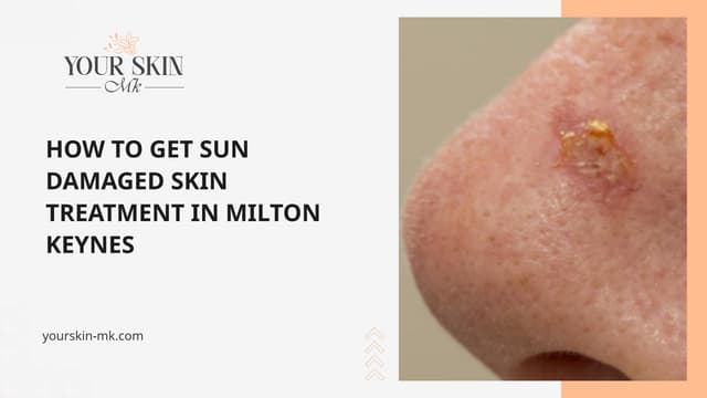 How to Get Sun Damaged Skin Treatment in Milton Keynes | PPTX