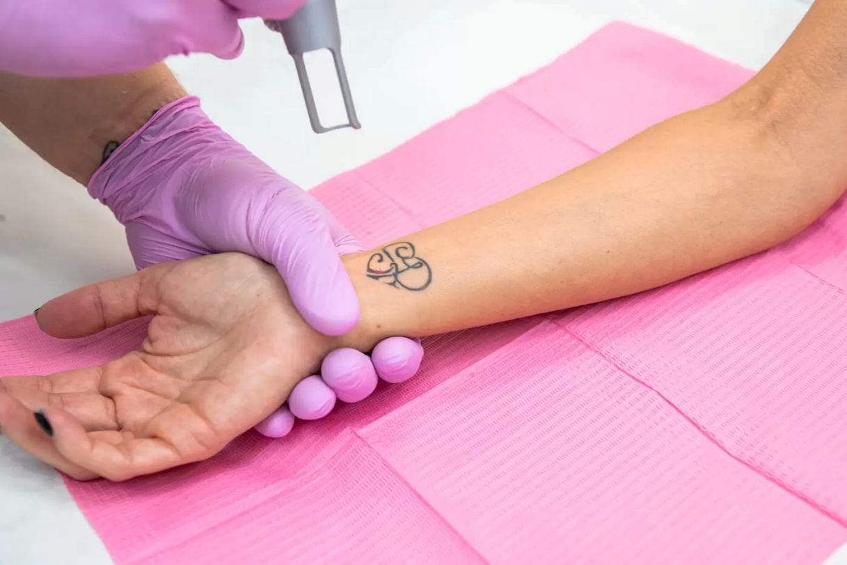5 Common Laser Tattoo Removal Mistakes and How to Avoid Them