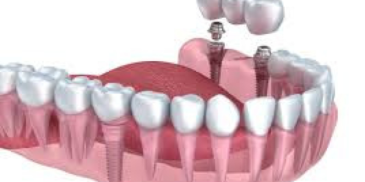 Top Signs You Need to Visit a Dental Implants Specialist in Glendale
