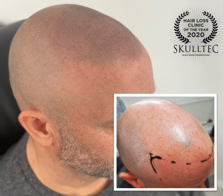 Scalp Micropigmentation in Glasgow