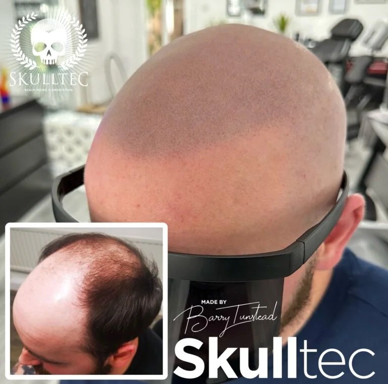 Scalp Micropigmentation Cost in Kent