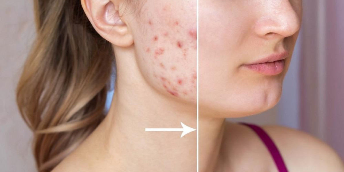 What is the Most Common Brand of Isotretinoin?