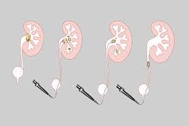 When Pain Demands Attention: A Human Look at Kidney Stone Care in Whitefield – @techt6090 on Tumblr