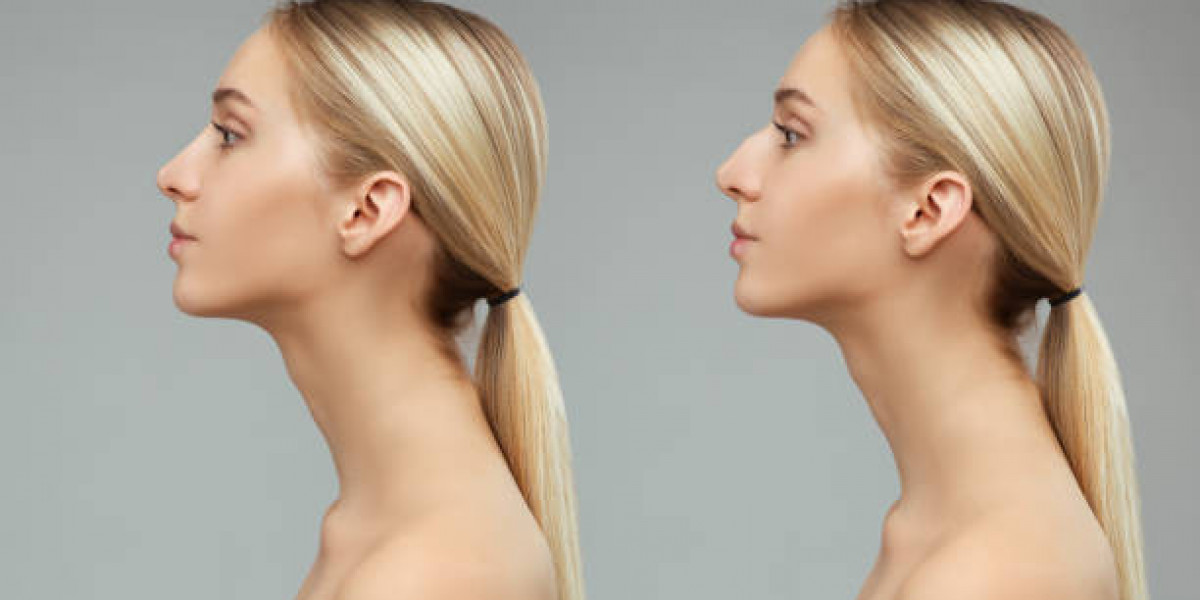 Does Smoking Impact Rhinoplasty Outcomes?