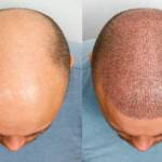 Hair Transplant in Riyadh Profile Picture