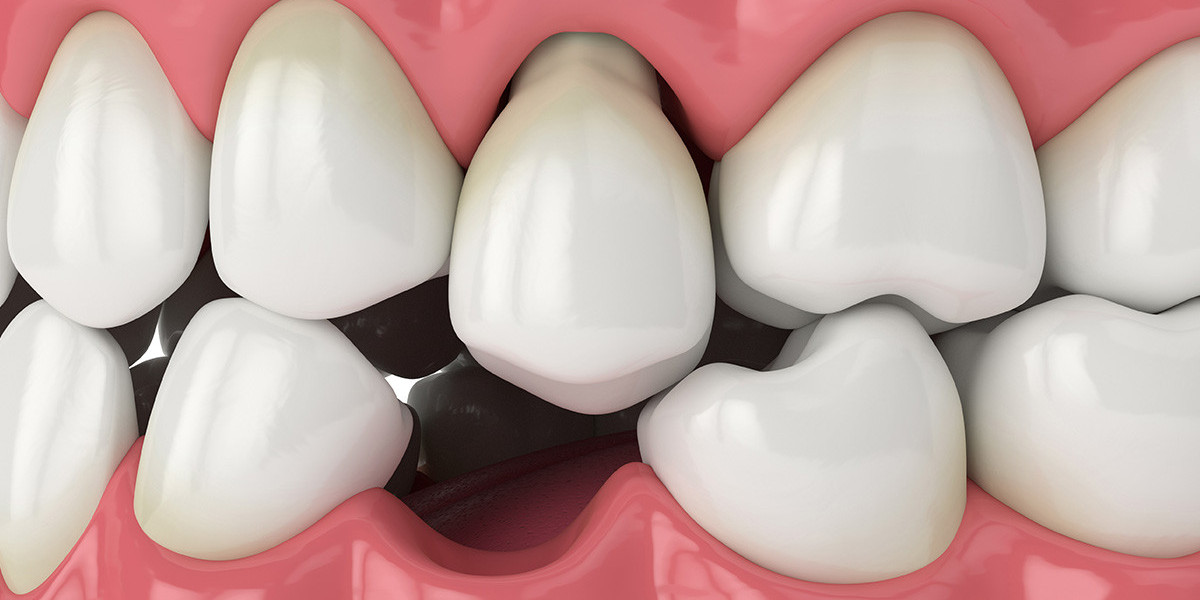 Signs You Need Missing Teeth Repair
