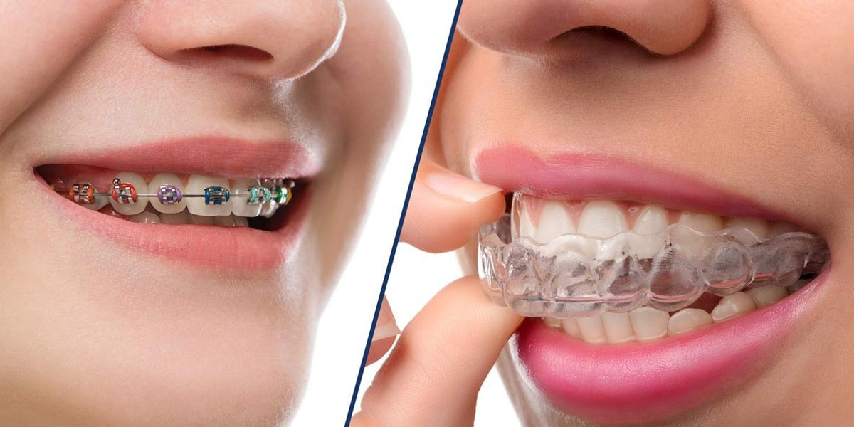 What Is Invisalign and How Does It Work?