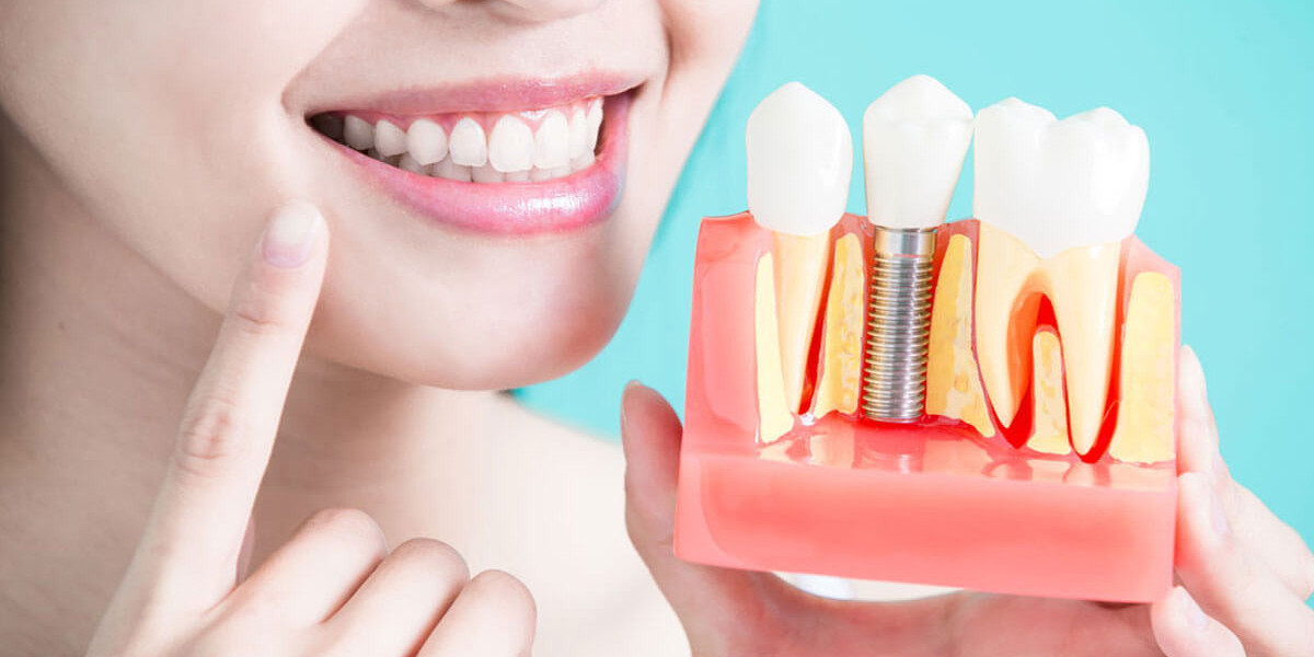 Benefits of Dental Implants for Oral Health