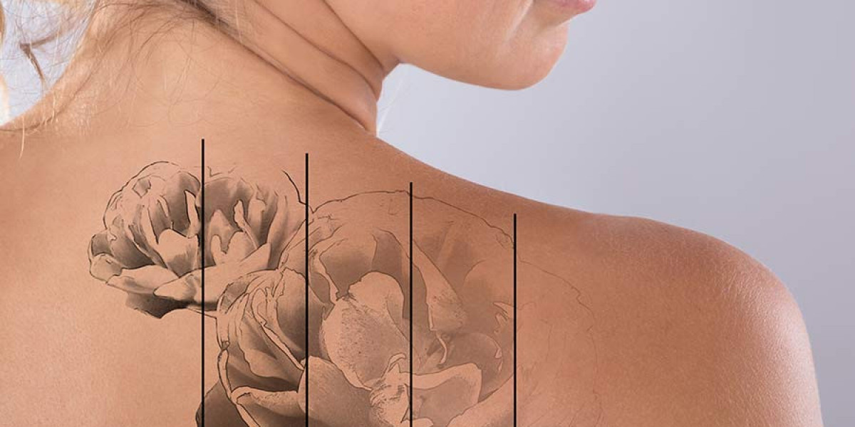 Laser Tattoo Removal Near Me Daytona Beach