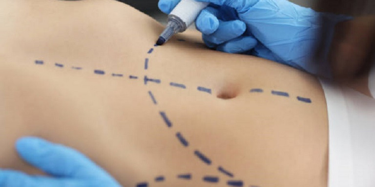 How Fractional Liposuction Targets Stubborn Fat