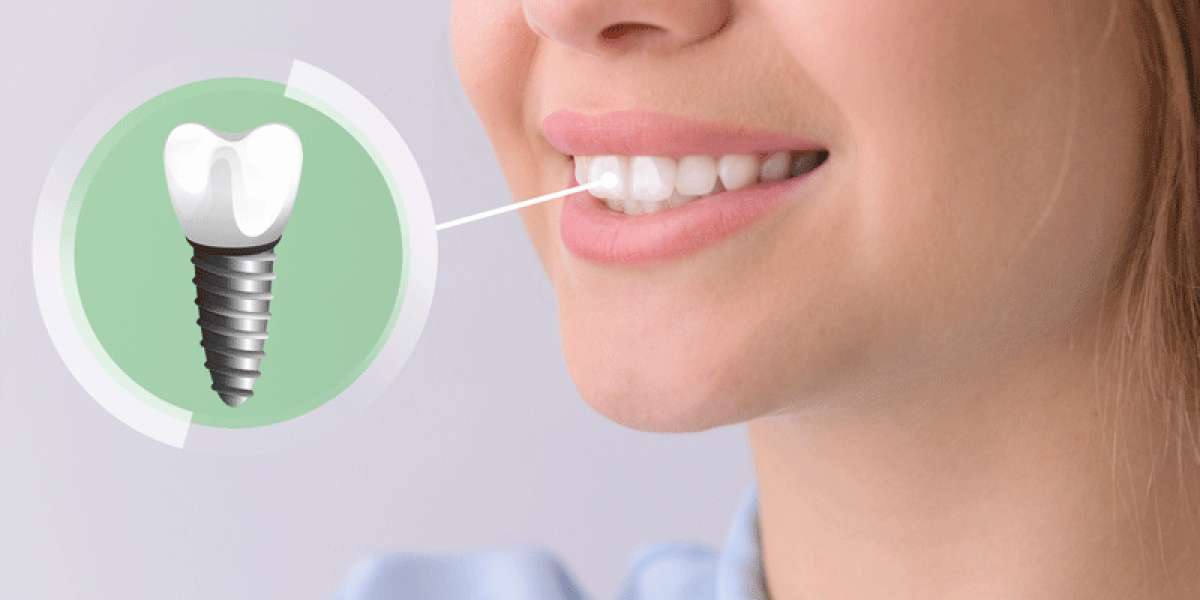 Are Dental Implants the Ultimate Solution for Teeth That Last Forever