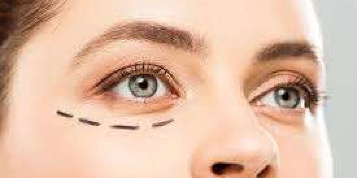 Factors That Affect Eyelid Surgery Prices