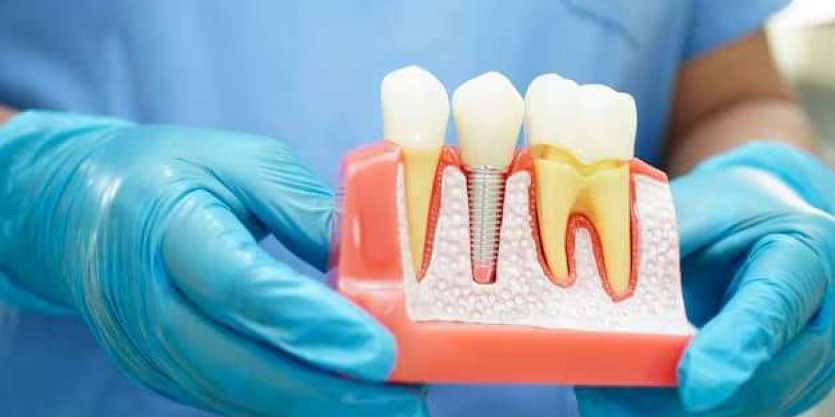 Dental Implants in Ventura vs Other Tooth Replacement Options