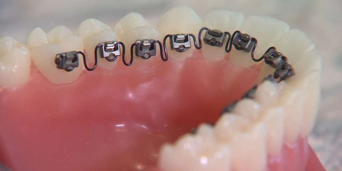 Dental Braces in Dubai for Bite Correction Treatment