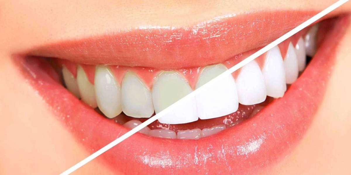 Teeth Whitening Cost in Dubai: Factors That Influence Pricing