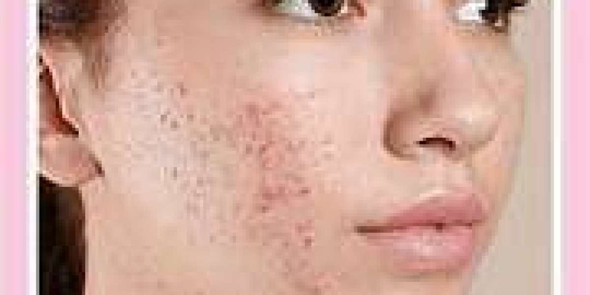 Acne Treatment in India - Achieve Flawless Skin with Expert Solutions with Advanced Dermatology Care | Essence Skin Care