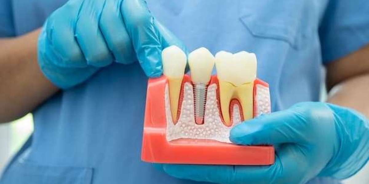 Why Digital Implant Planning Is Improving Dental Implants Dubai Success Rates