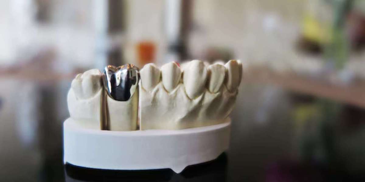 Dental Crowns in Sherman Oaks: Costs Explained