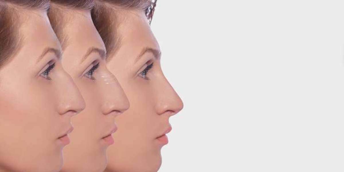 Rhinoplasty: Enhance Facial Harmony Effortlessly