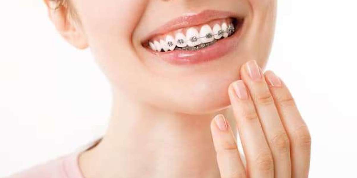 Why Adults Are Choosing Ceramic Teeth Braces Over Metal Braces