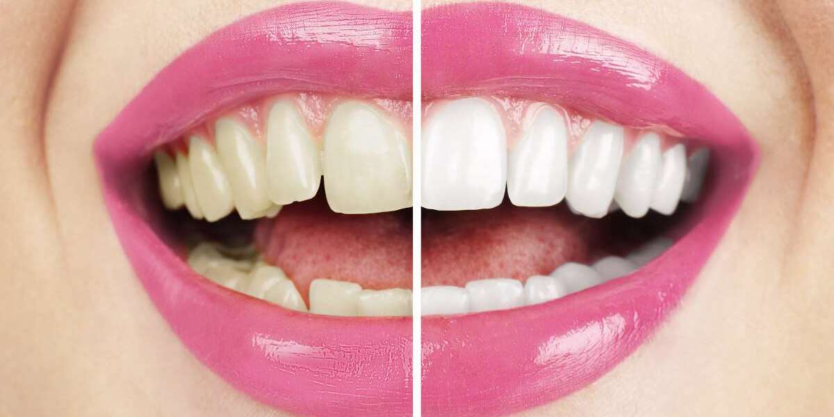 Step Into Fresh Glow with the Best Teeth Whitening in Dubai
