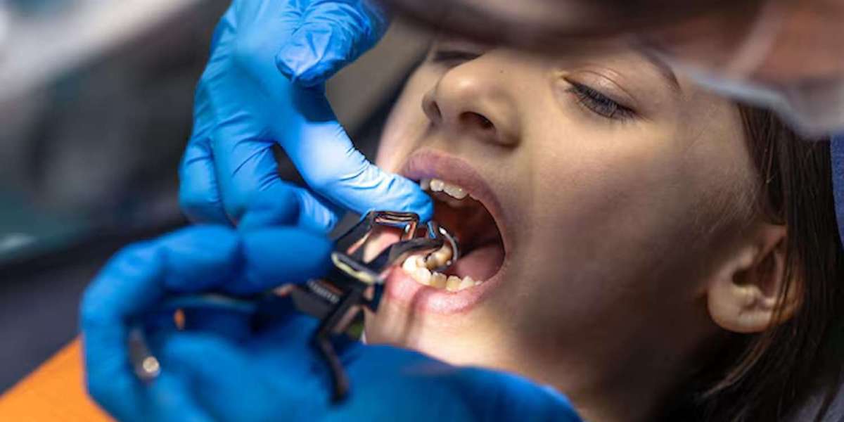 When Do You Need Tooth Extractions in Westport?