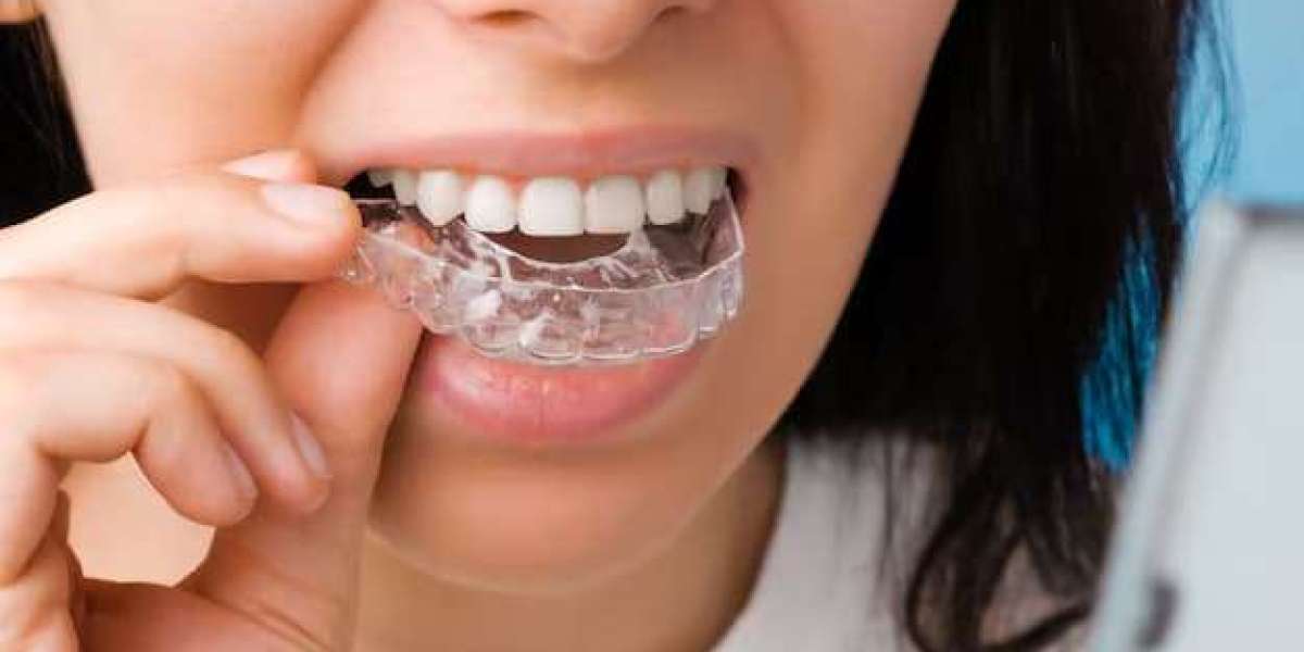 Clear Aligners for Teeth Choosing the Right Dentist or Orthodontist