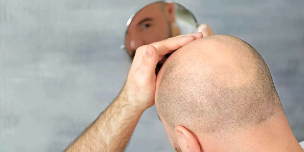 How Is Hair Transplant in Dubai Performed Step by Step?