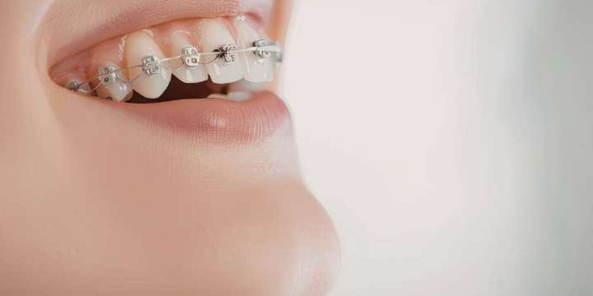 Understanding the Cost of Braces in Australia: A Complete Guide