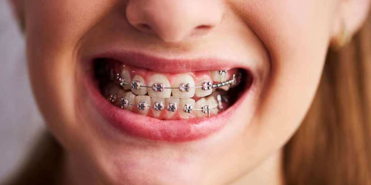 Benefits of Traditional Metal Braces for Teeth Alignment