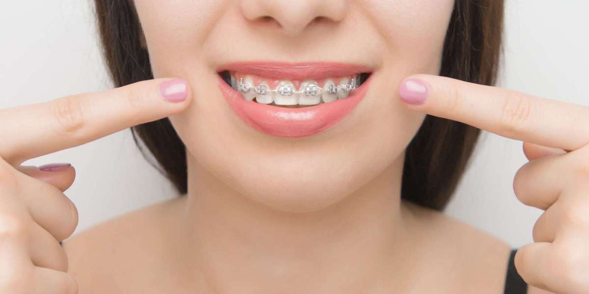 Dental Braces in Dubai: Pain & Care Tips