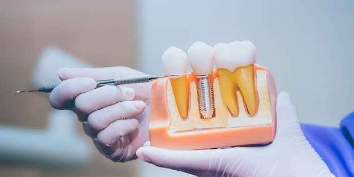 Tooth Implant in Beverly Hills: Replace Missing Teeth Confidently