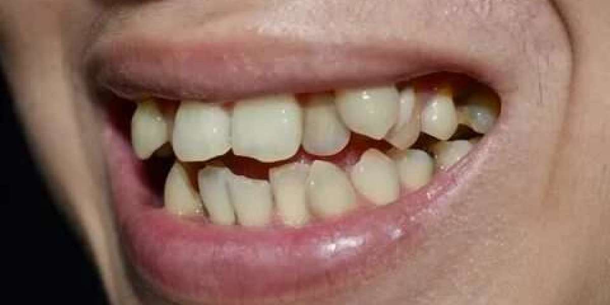 How to Prepare for Crowded Teeth Treatment: A Simple Guide