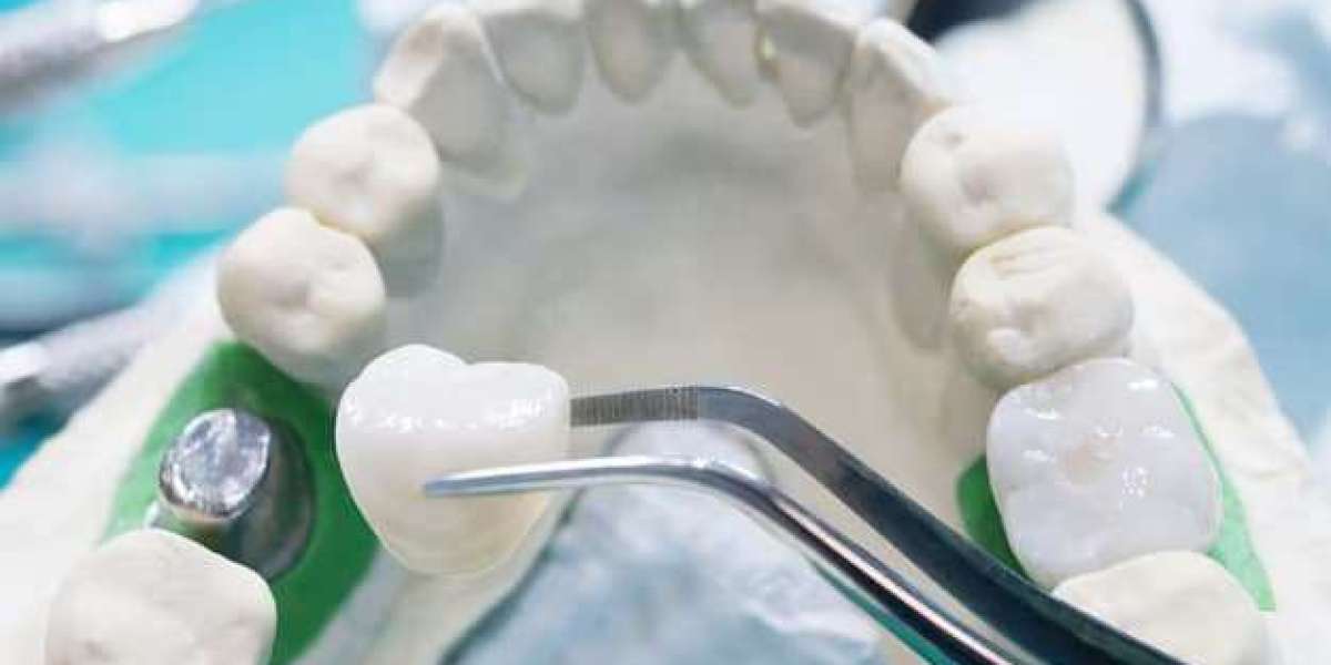 Reviews Matter: Choosing Dental Crowns Near Me