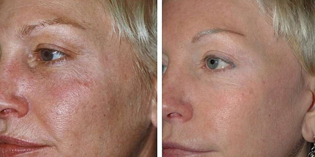 Can Fractional CO2 Laser Treatment Improve Skin Texture?