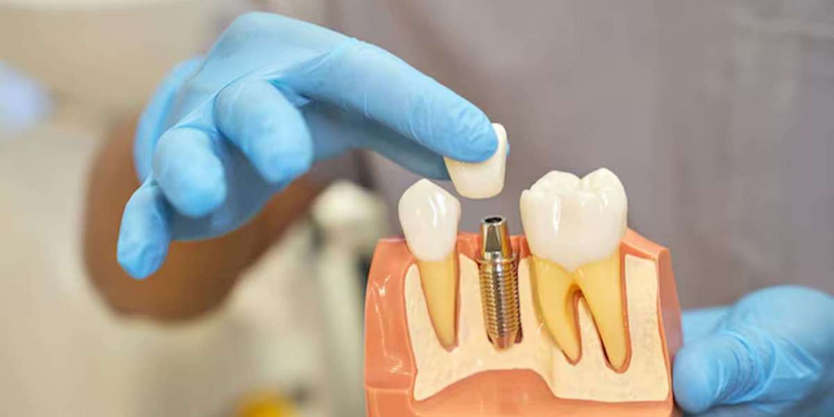 Complete Guide to Dental Implants in Sherman Oaks