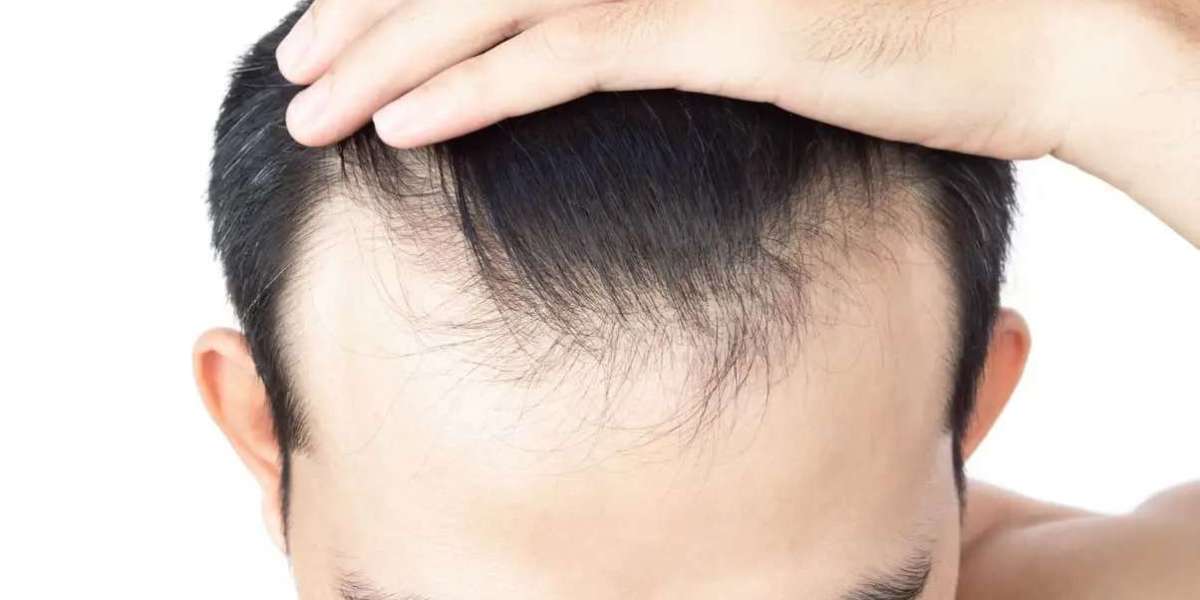 What Role Does Precision Planning Play in Hair Transplant Success?