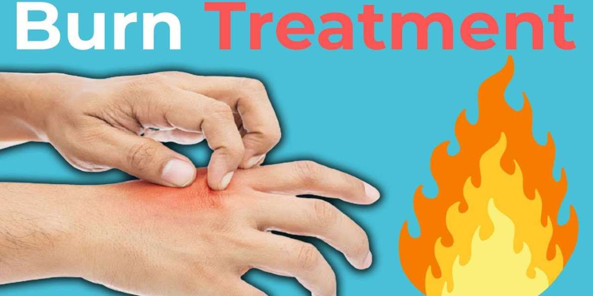 Best Burn Treatment Practices Recommended by Doctors