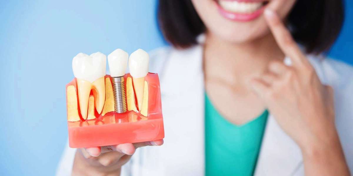 Dental Implant Cost In Dubai Success Rate Guide