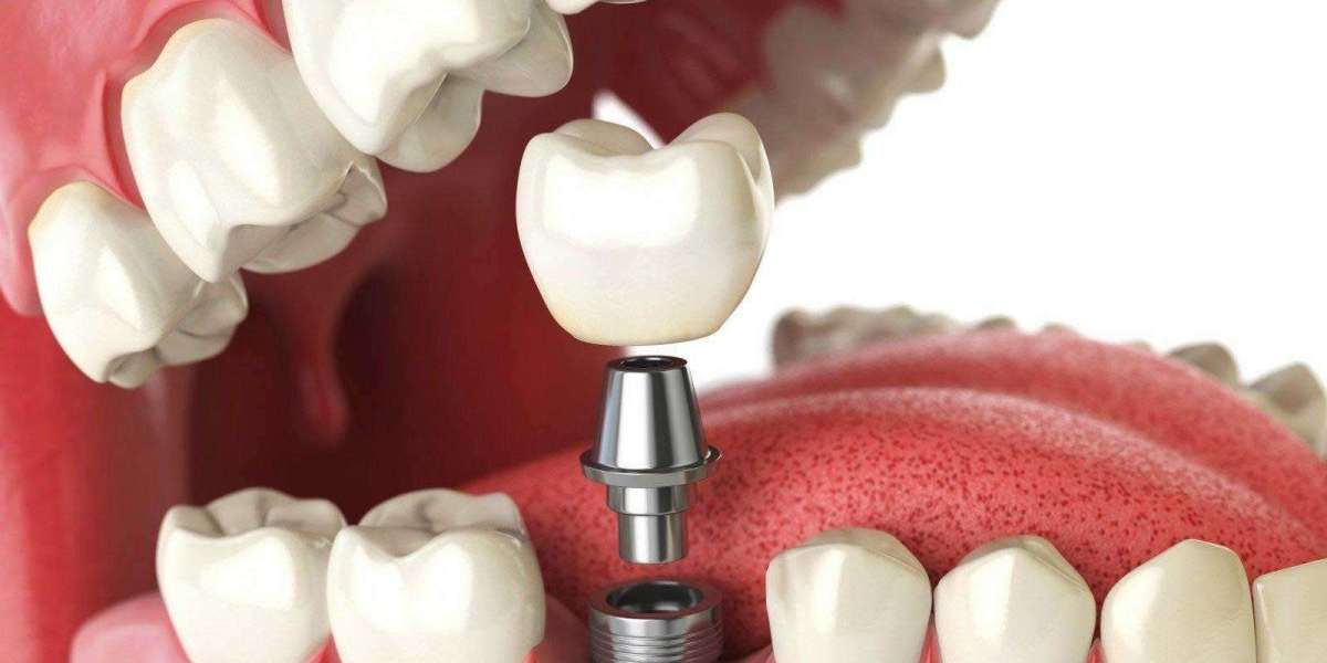 Dental Implant Cost In Dubai: What Affects Price