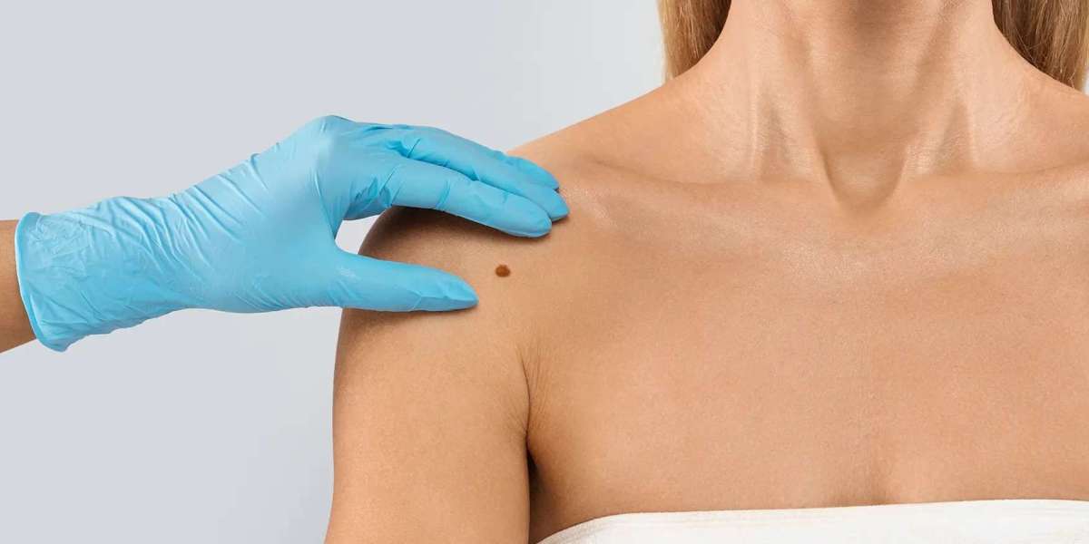 How Do Dermatologists Determine the Best Skin Tag Removal Approach?
