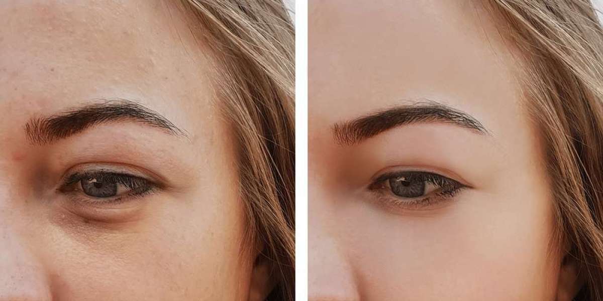 How Can Under Eye Filler Brighten Tired Eyes And Lift Eye Contours