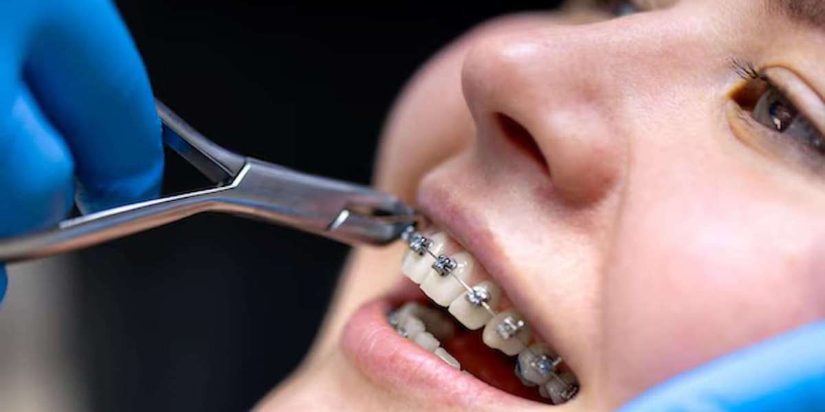 Traditional Metal Braces for Teenagers and Adults