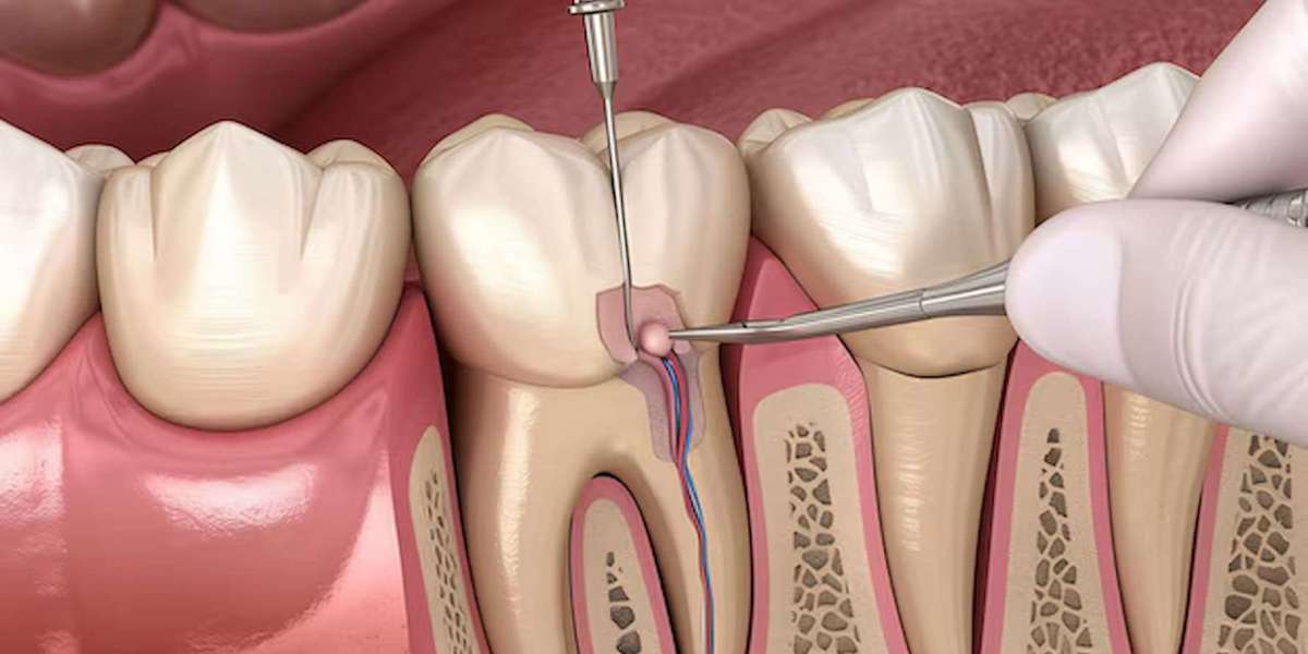 Myths About Root Canal Treatments Debunked