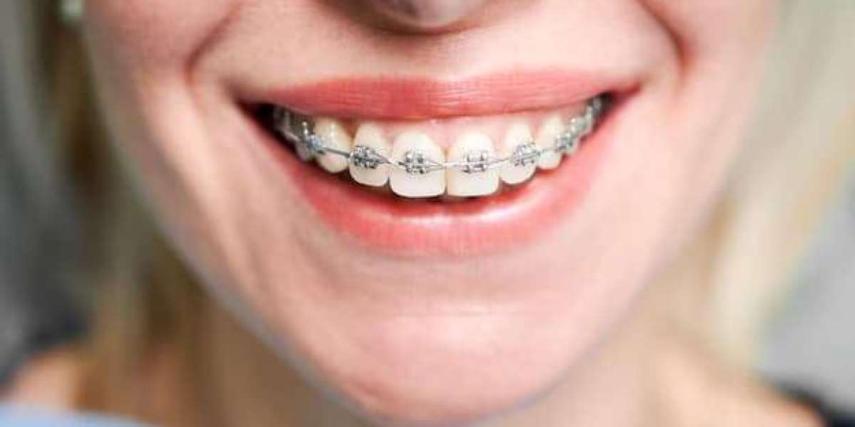 Teeth Braces Near Me: Options for a Perfect Smile