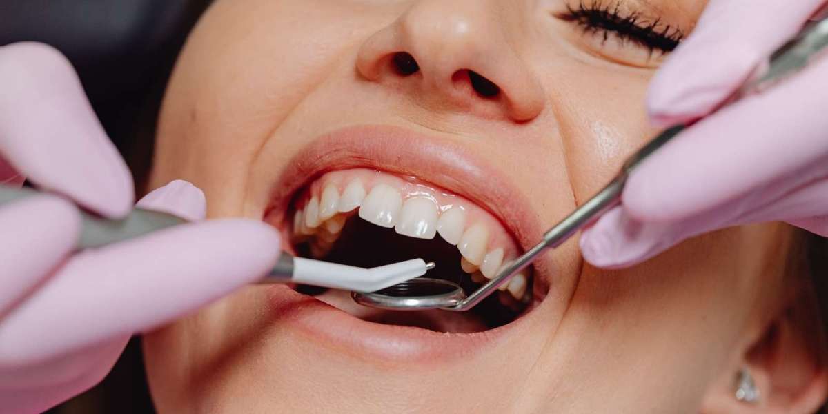 Dental tooth removal In Dubai: Expert Dentist Advice