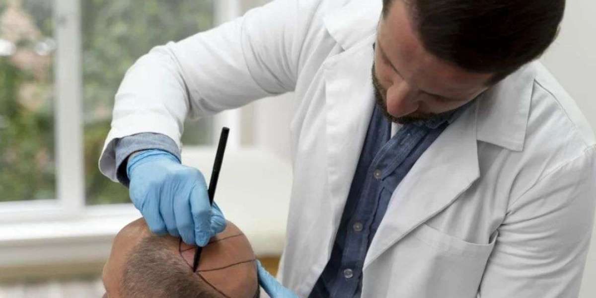 What to Expect During Your Hair Transplant Day?